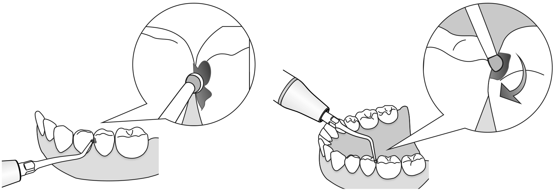 Сфера применения наконечника для скалера